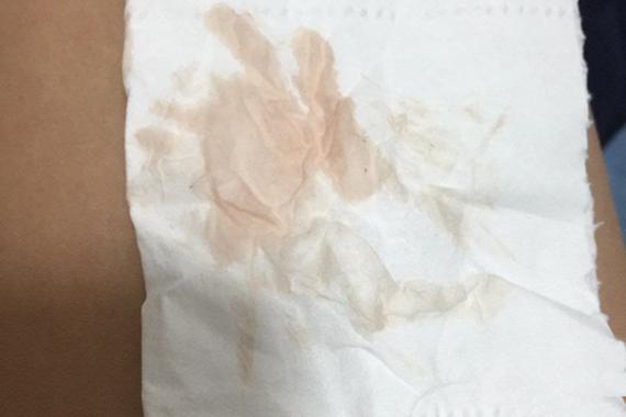 着床成功后出血图片解析:正常症状与异常情况对比指南(附高清图) 着床成功后出血图片解析:正常症状与异常情况对比指南(附高清图)
